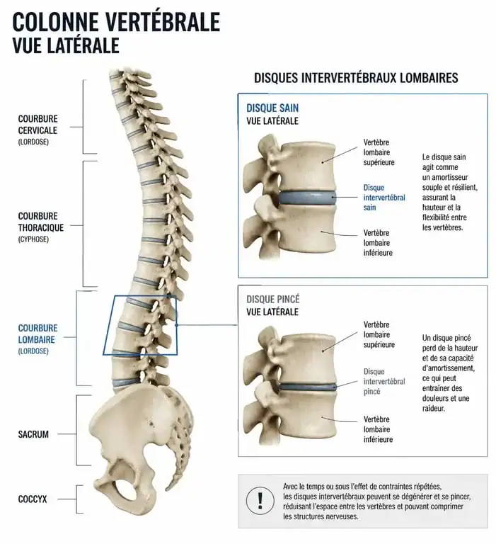 Schéma illustrant un pincement discal entre deux vertèbres lombaires pour comprendre la mécanique du dos lors de la marche